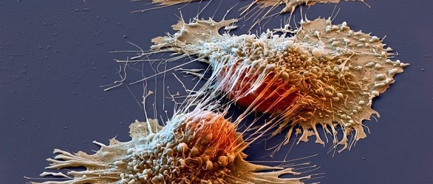 Ученые узнали, каким образом раковые клетки организуют опухоли