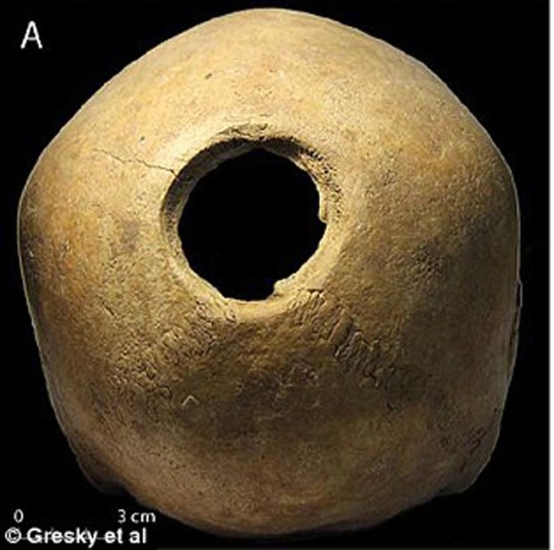 Зачем сверлили дырки в головах 11 тысяч лет назад?