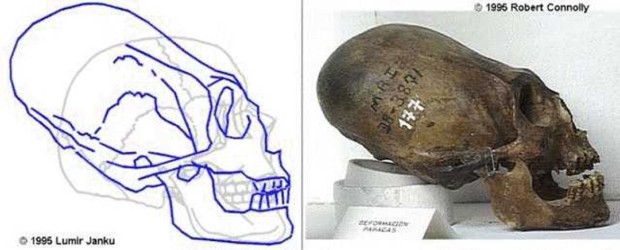 Зачем сверлили дырки в головах 11 тысяч лет назад?