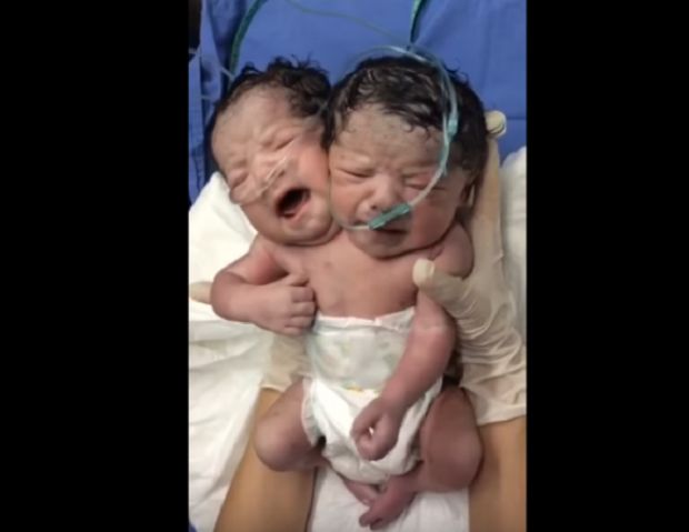 В Мексике родился двухголовый младенец