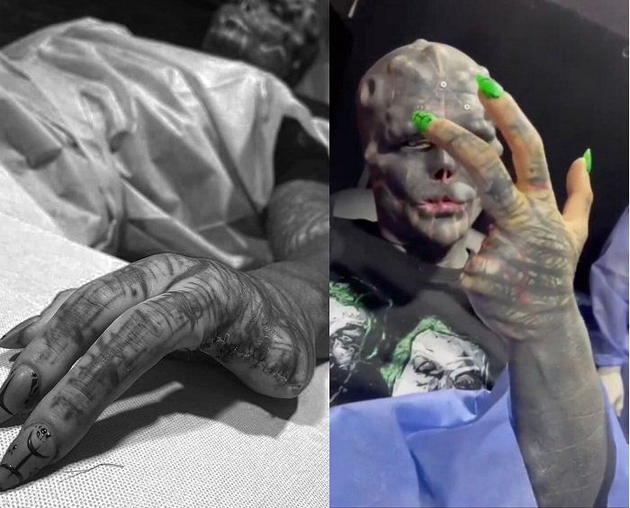 Мужчина удалил пальцы, нос, губу и уши в попытке стать инопланетянином