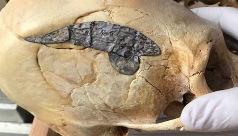 2000-летний удлиненный череп с имплантированным куском металла