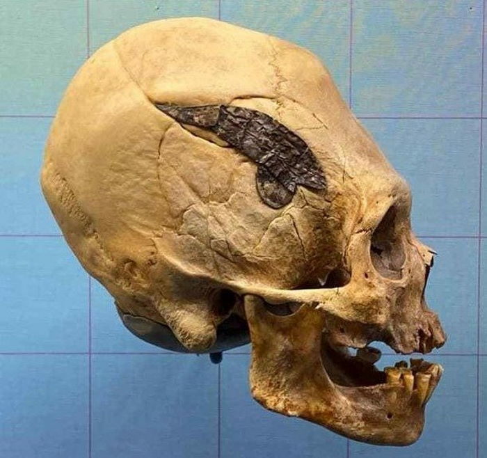2000-летний удлиненный череп с имплантированным куском металла