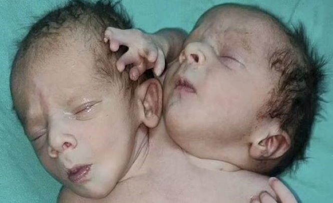 В Индии родился ребенок с двумя головами и тремя руками