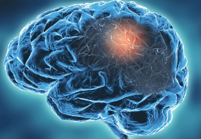 Когнитивное воздействие тяжелого COVID равно 20 годам старения мозга