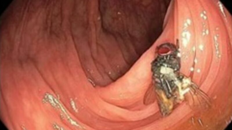 Врачи обнаружили в кишечнике пациента живую муху