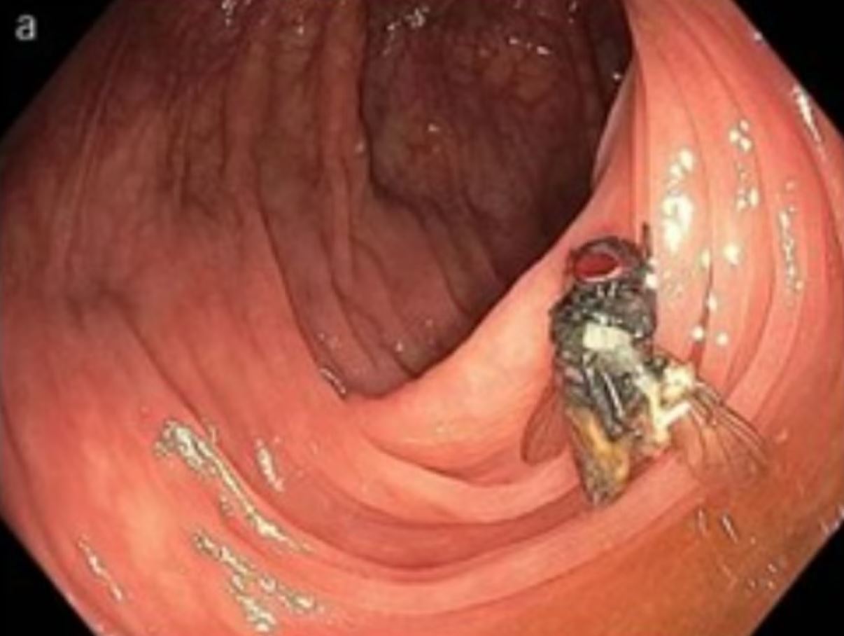 Врачи обнаружили в кишечнике пациента живую муху