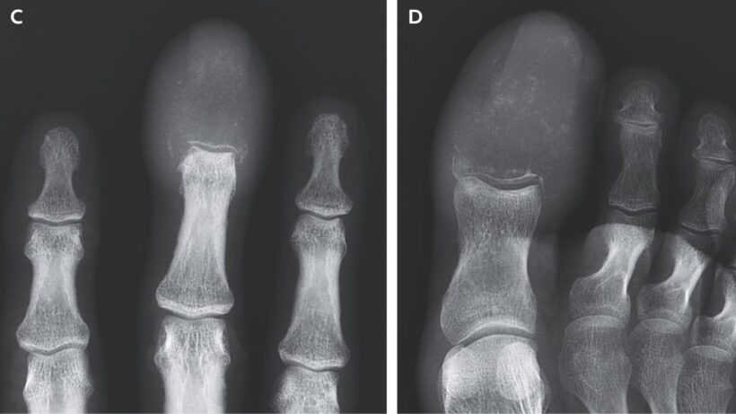 Редкое проявление онкологии: Как отёк пальцев выдал метастазы рака лёгких