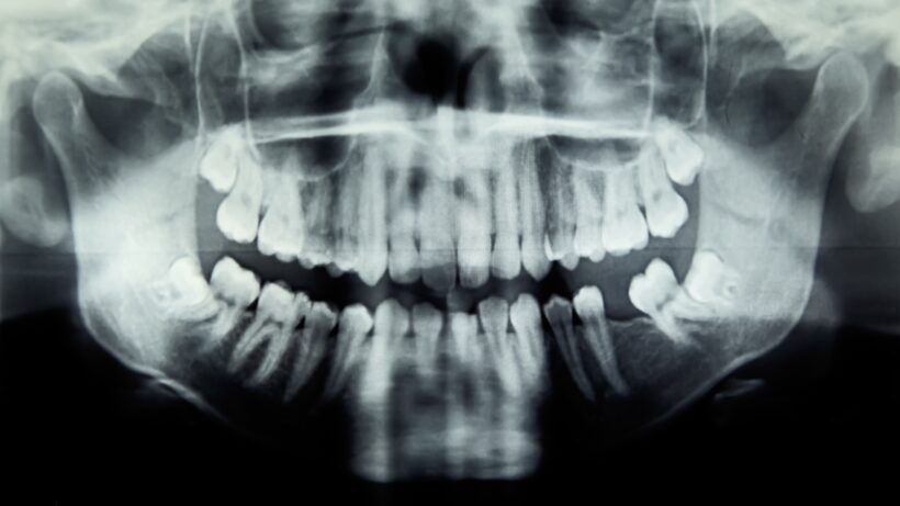 Тяжёлый случай: как зубная инфекция привела к опасному осложнению у ребёнка