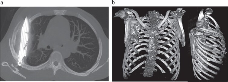 CT-сканирование и 3D-визуализация ножа в грудной клетке
