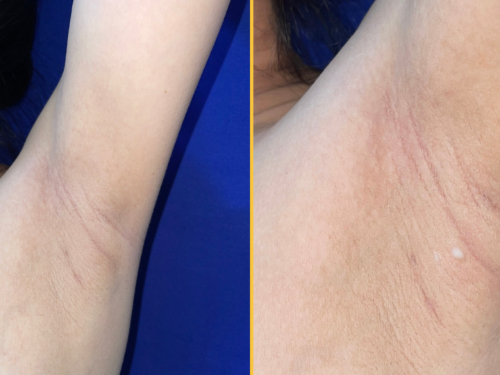 Уникальная история о полимастии: Как необычные припухлости в подмышках стали загадкой