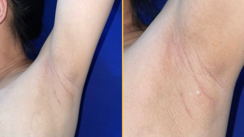 Уникальная история о полимастии: Как необычные припухлости в подмышках стали загадкой