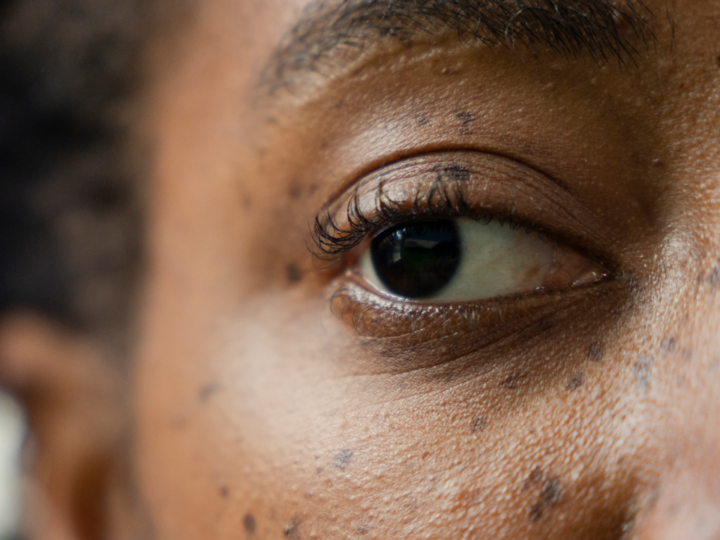 «Перезагрузка» зрения: как «отключение» ленивого глаза может восстановить зрение у взрослых