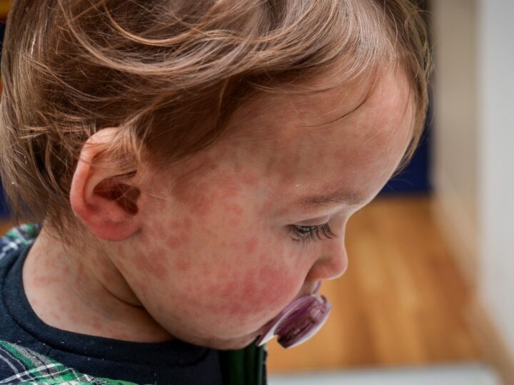 У Великобритании отобрали статус по ликвидации кори: Что это означает?