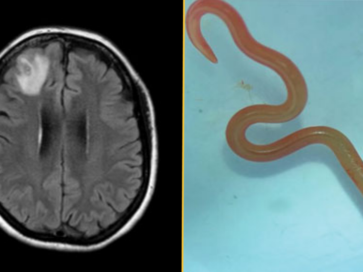 Гость из мозговых извилин: как в голове женщины поселился ярко-красный червь